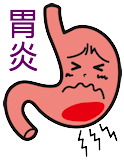 胃炎